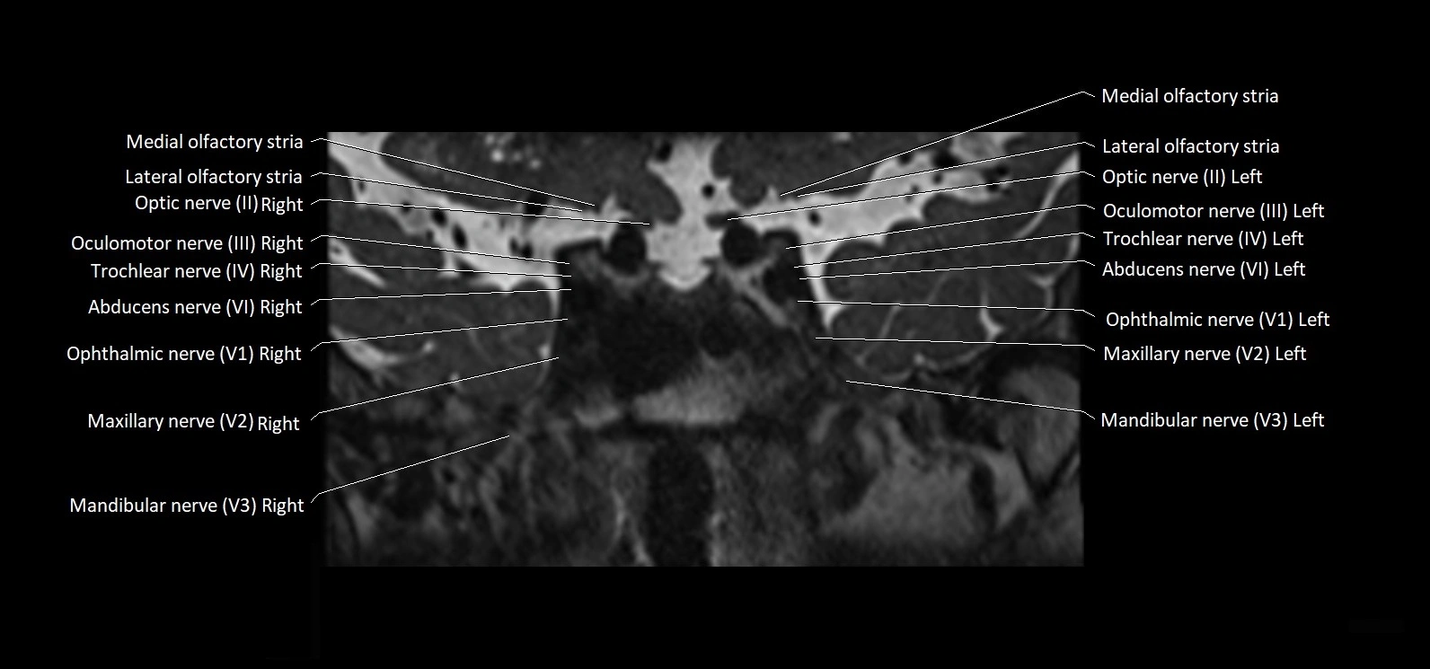 Cranial nerve cross sectional anatomy coronal 3T MRI image 25.webp
